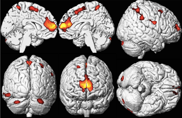neurological-disorder