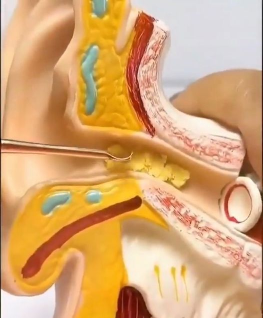 ear-infection