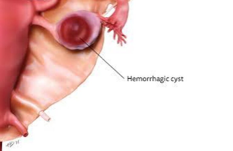 OVARY HEMORRHAGIC CYST