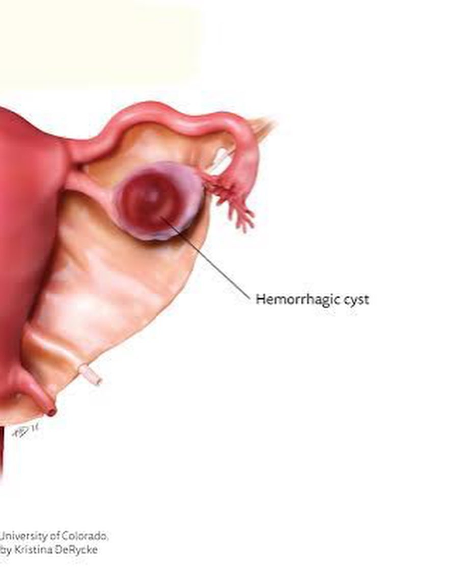 OVARY HEMORRHAGIC CYST