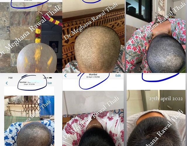 Homeopathy-Hair Fall-Thin Hair-Hair Transplant
