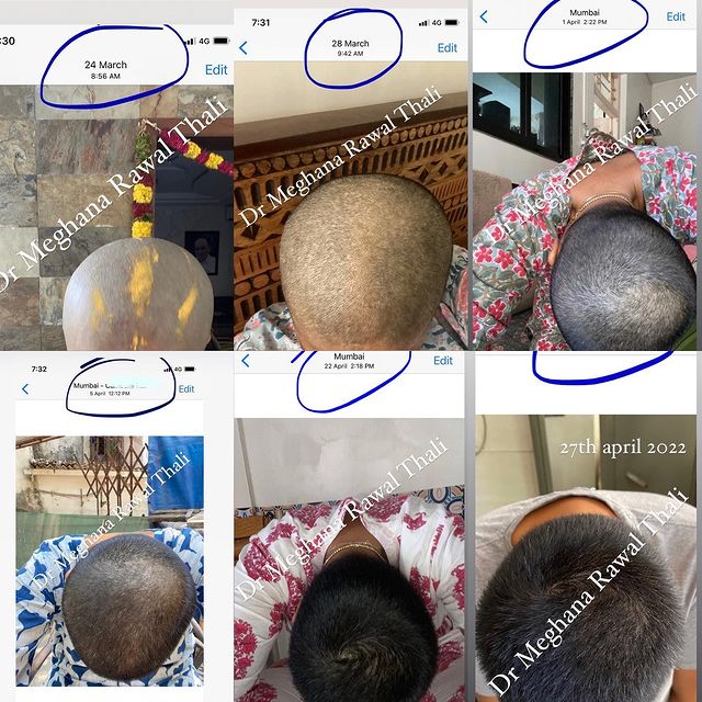 Homeopathy-Hair Fall-Thin Hair-Hair Transplant