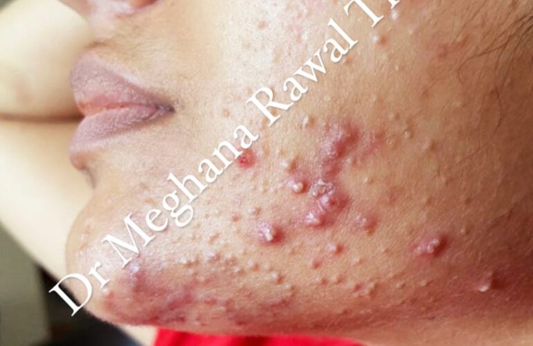 bach-flowe-Acne pustules