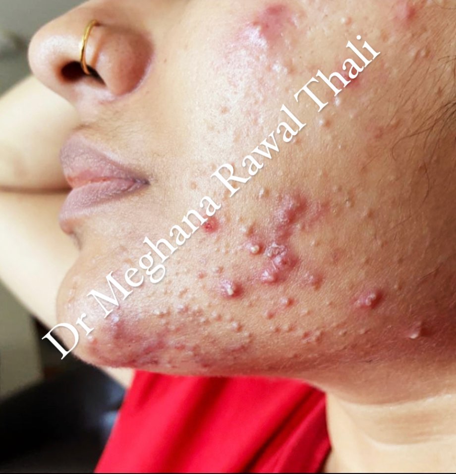 bach-flowe-Acne pustules