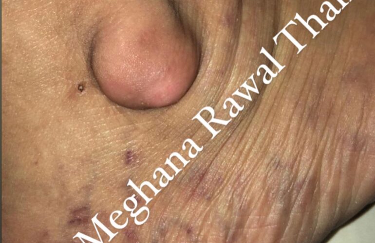 Ganglion cyst is a fluid-filled lump