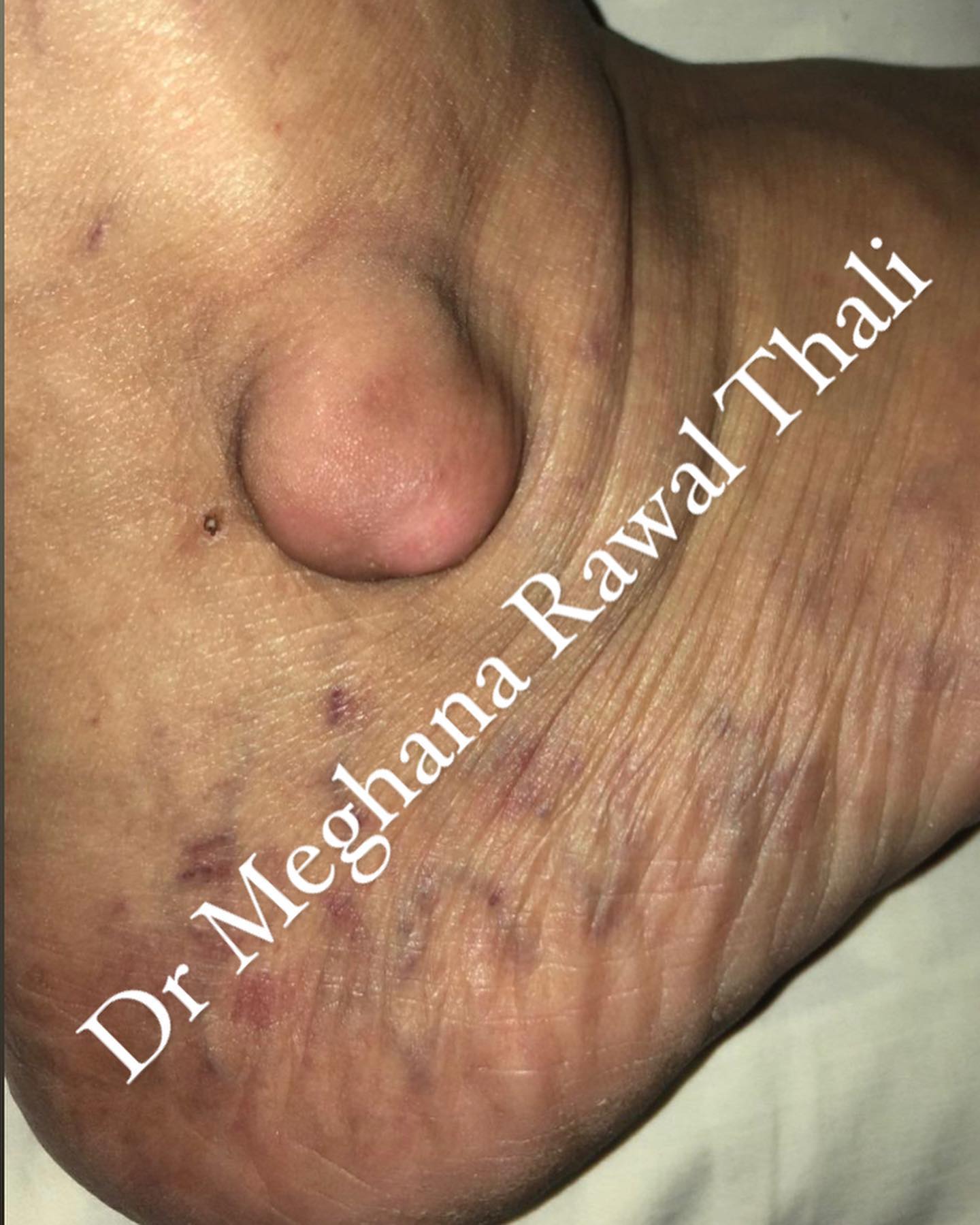 Ganglion cyst is a fluid-filled lump