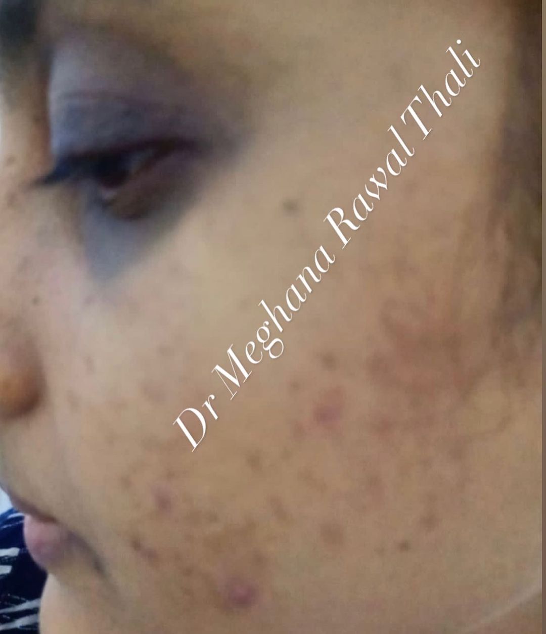 dark-circle Face