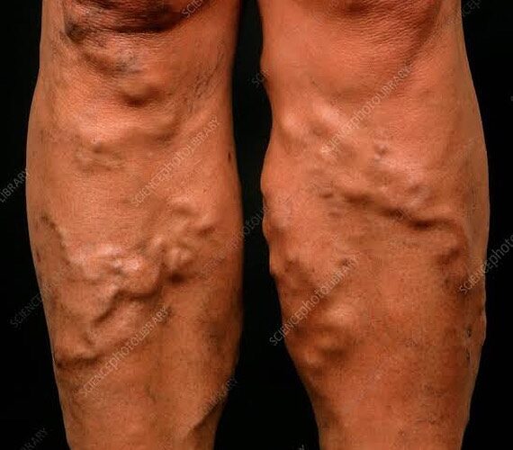 spider-vein