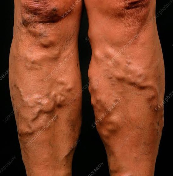 spider-vein