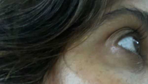 Crow's feet, laugh lines,wrinkles