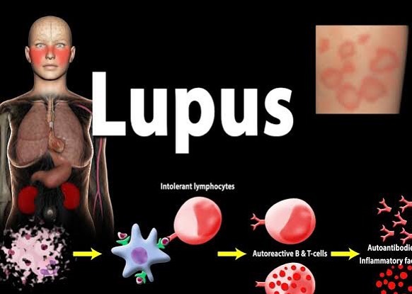 LUPUS & HOMOEOPATHY