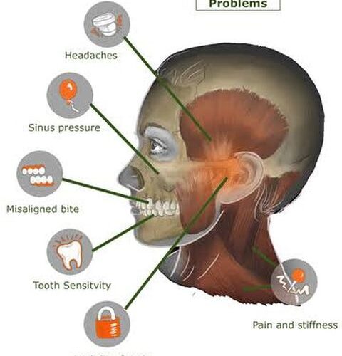 Temporomandibular joint (TMJ) disorders