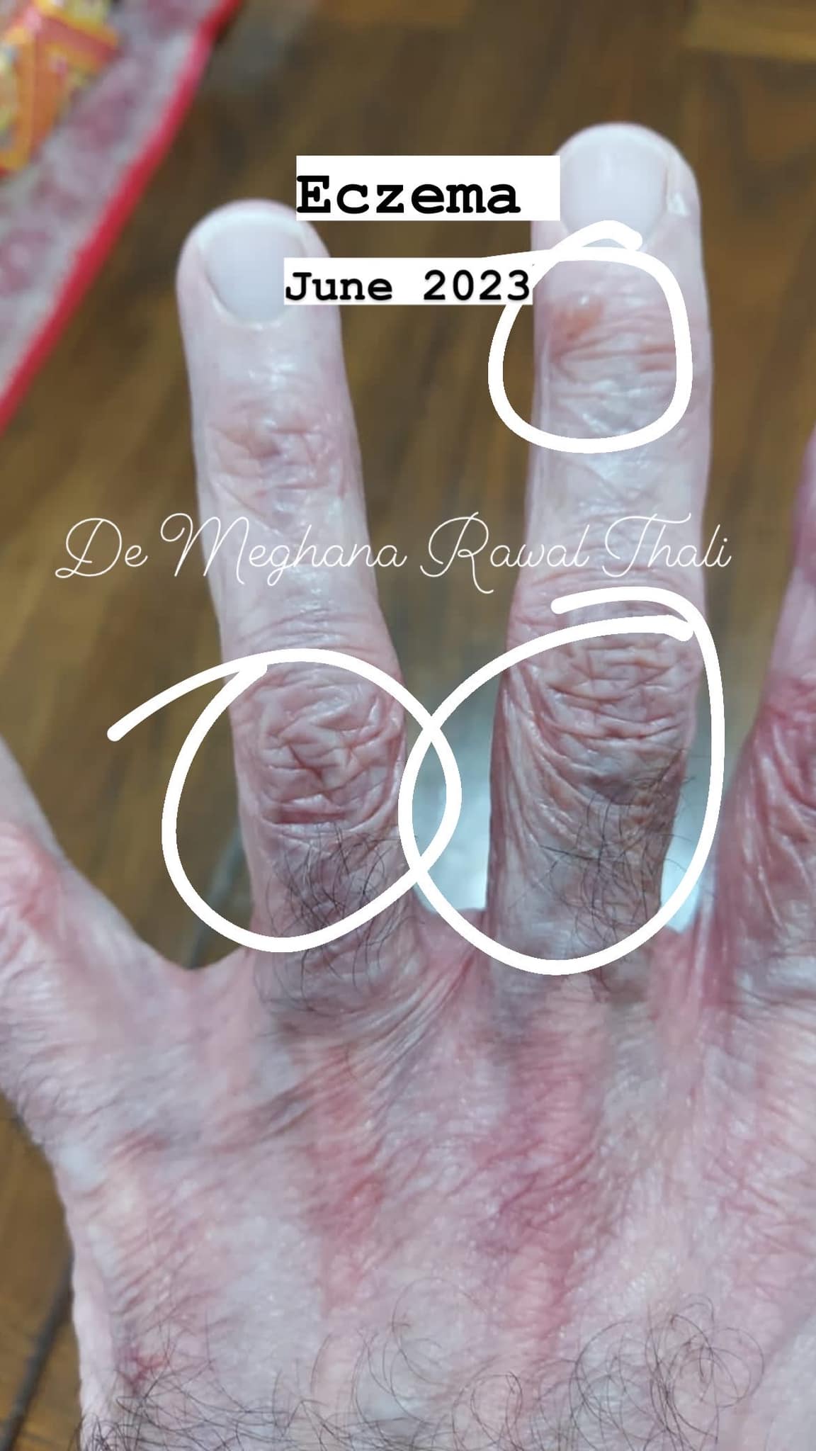 eczema