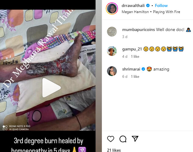 burn-heal-case