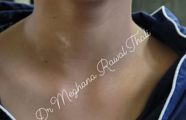 torticollis