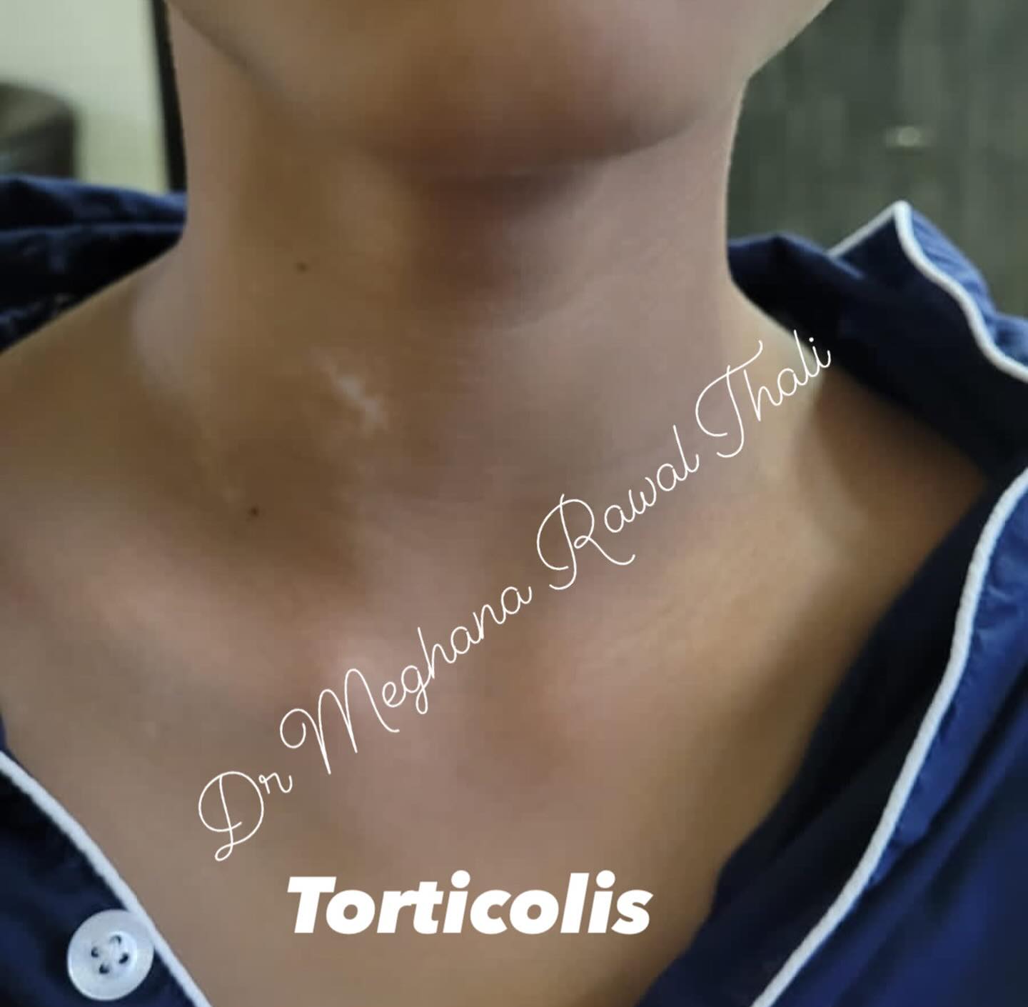 torticollis