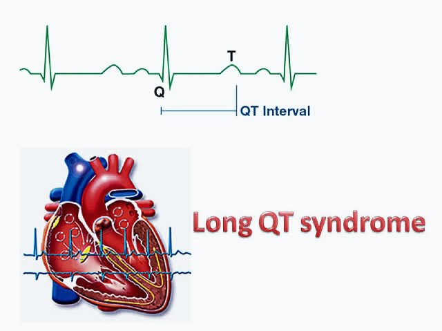 LONG QT SYNDROME