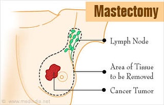 MASTECTOMY