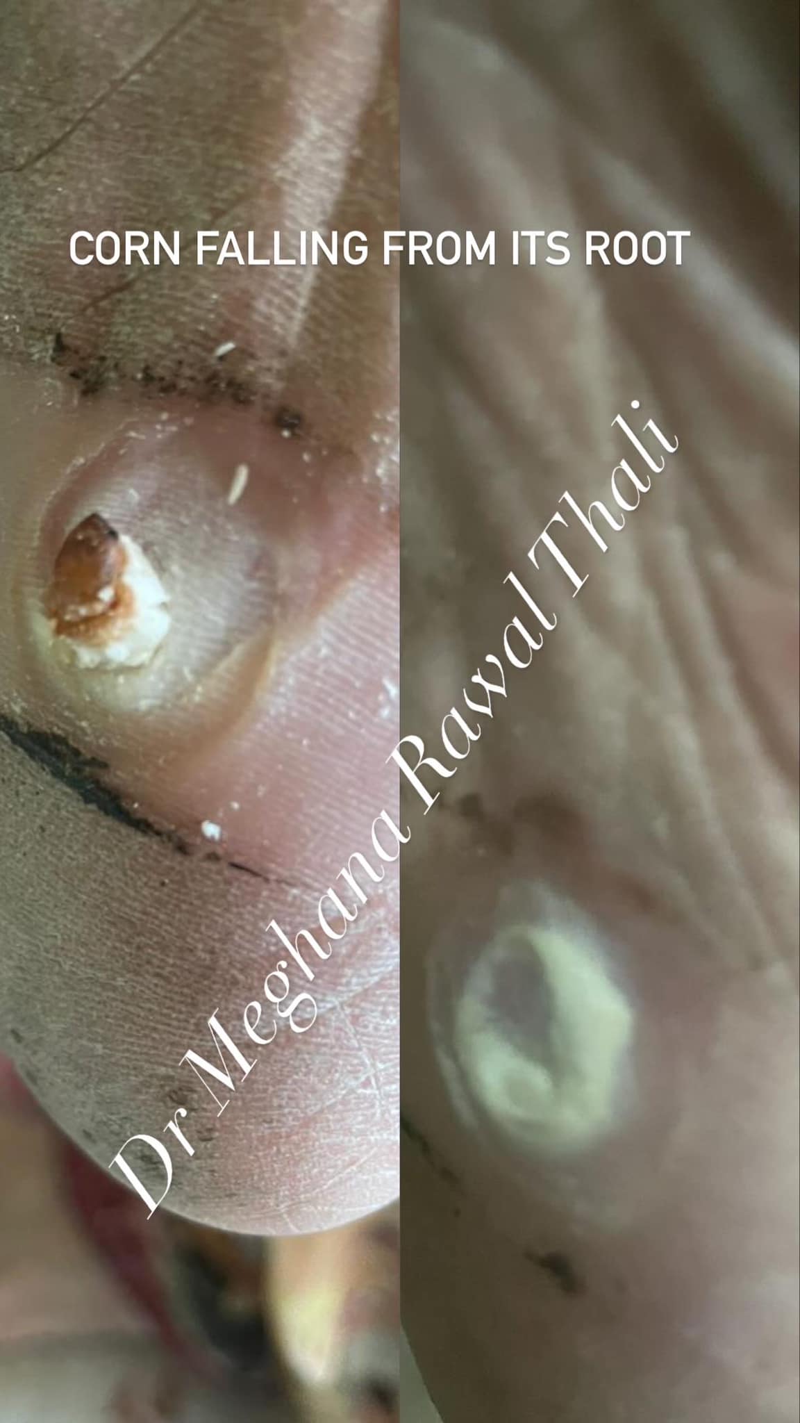 Calluses