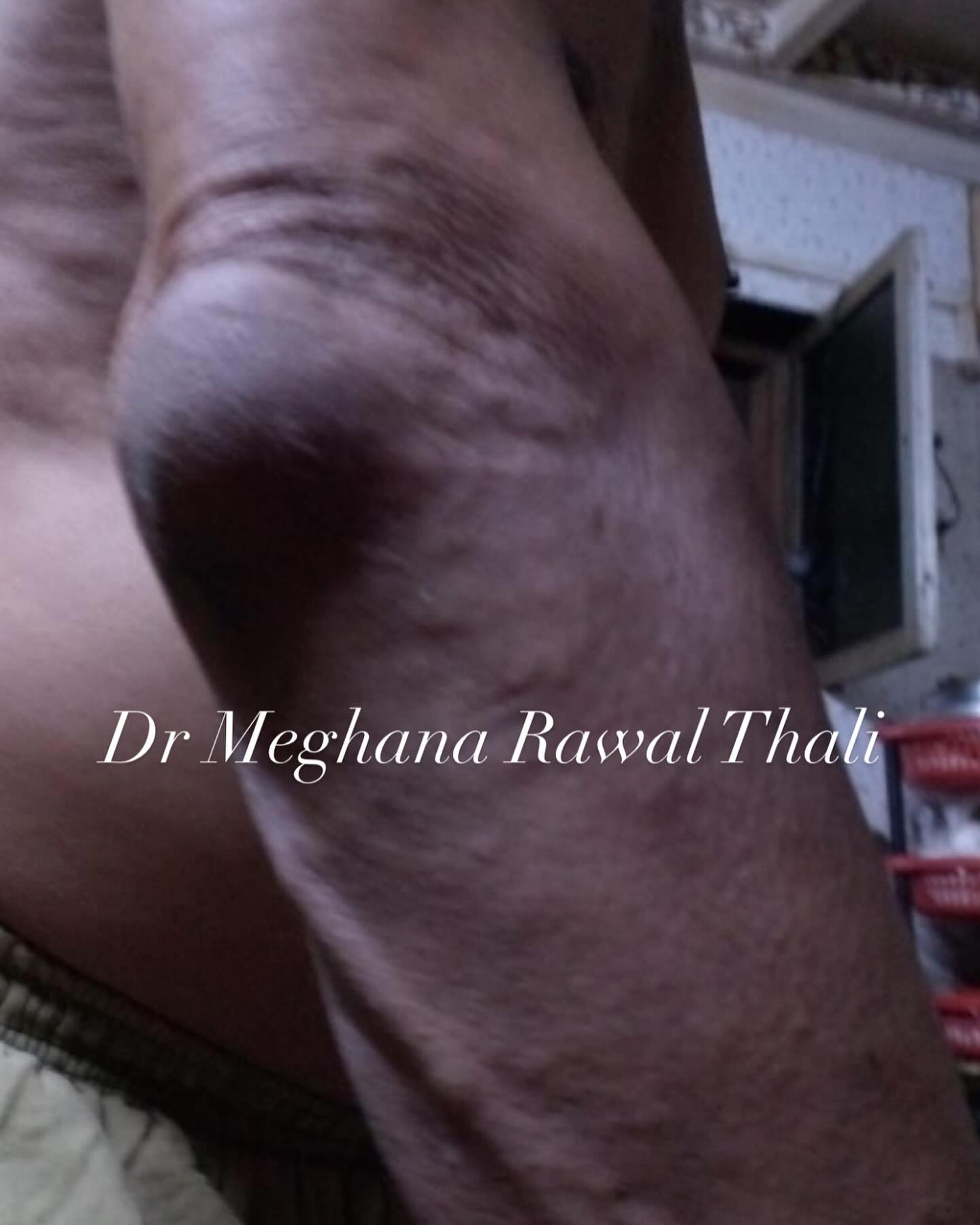 Olecranon bursitis