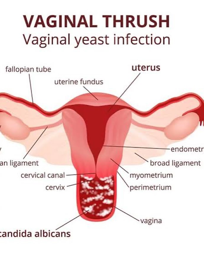 Vaginal infection