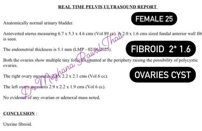 PCOD & FIBROID