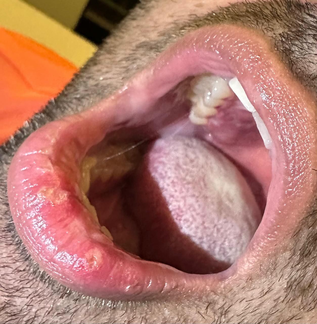 Aphthous Healing