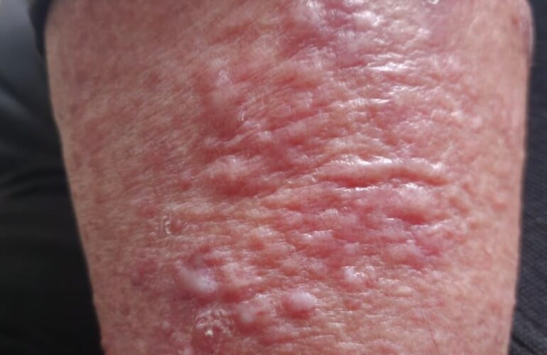 Cellulitis
