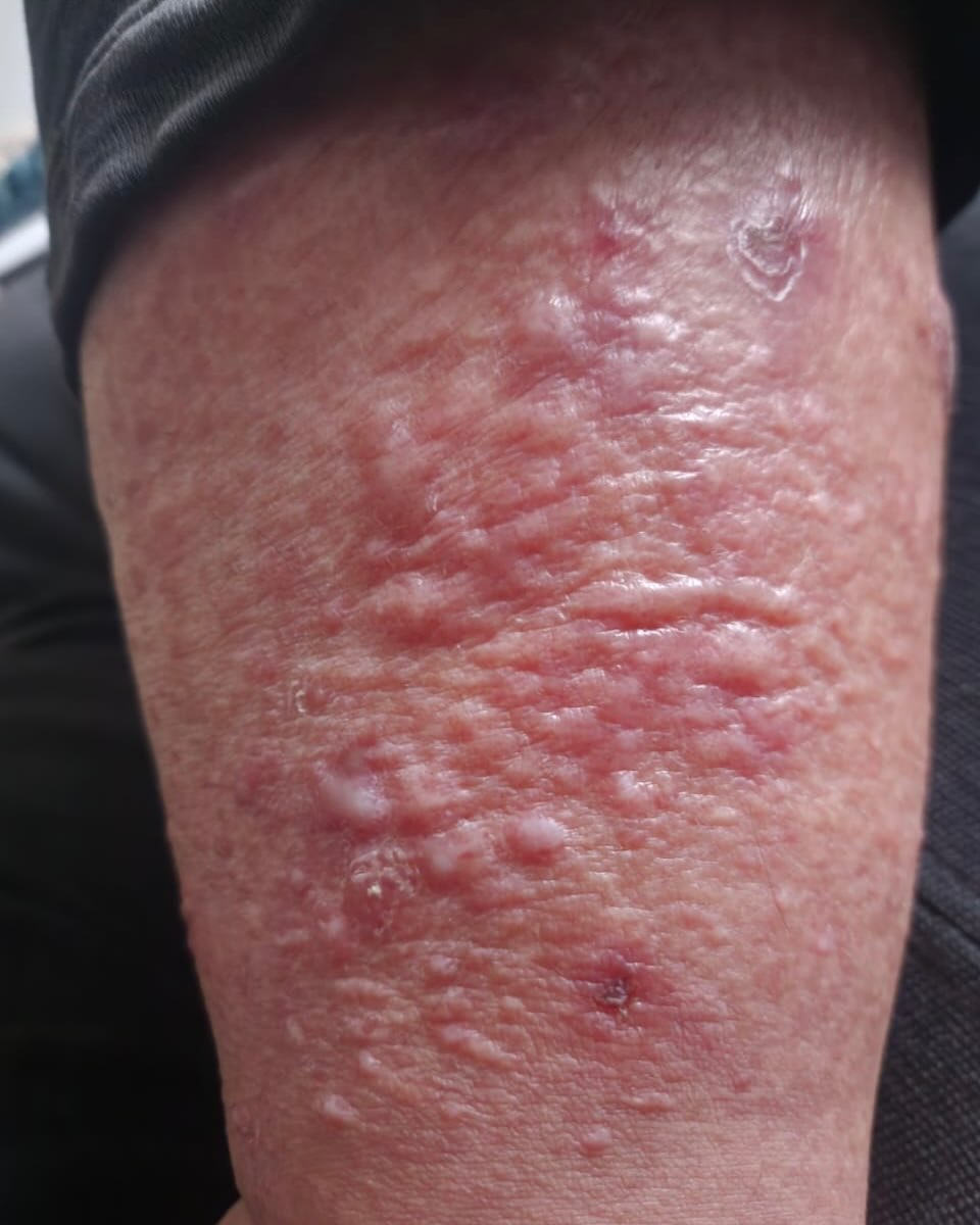 Cellulitis