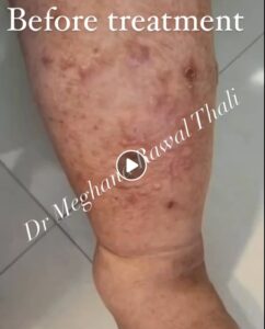 Before Treatment at Dr RawalThali’s Holistic Homoepathy Clinic
