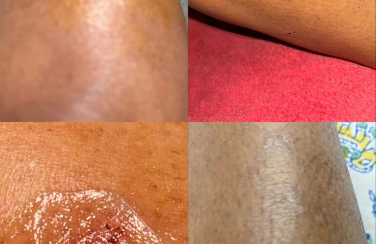 Deep wound requiring stitches healed in 5 days