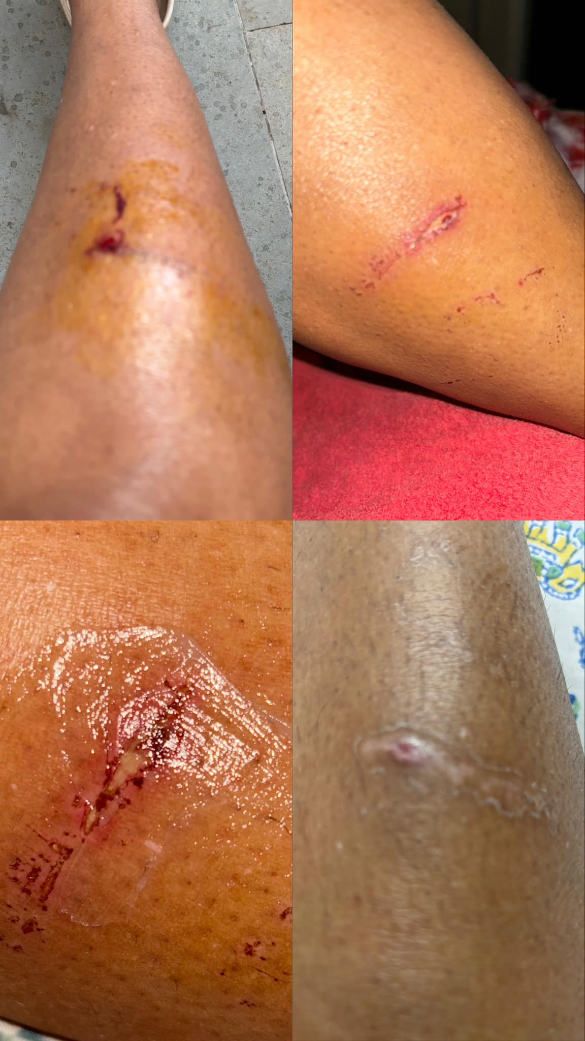Deep wound requiring stitches healed in 5 days