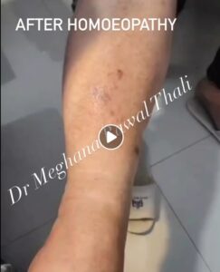 Cellulitis- After Treatment at Rawal Thali Clinic