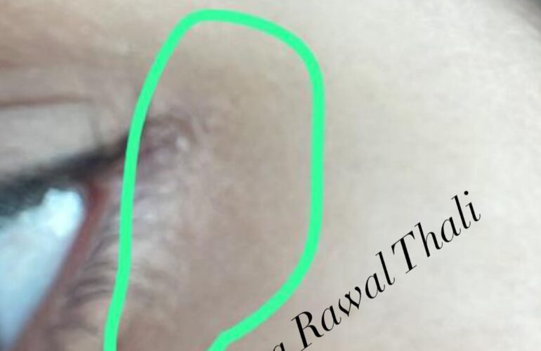 XEROSIS