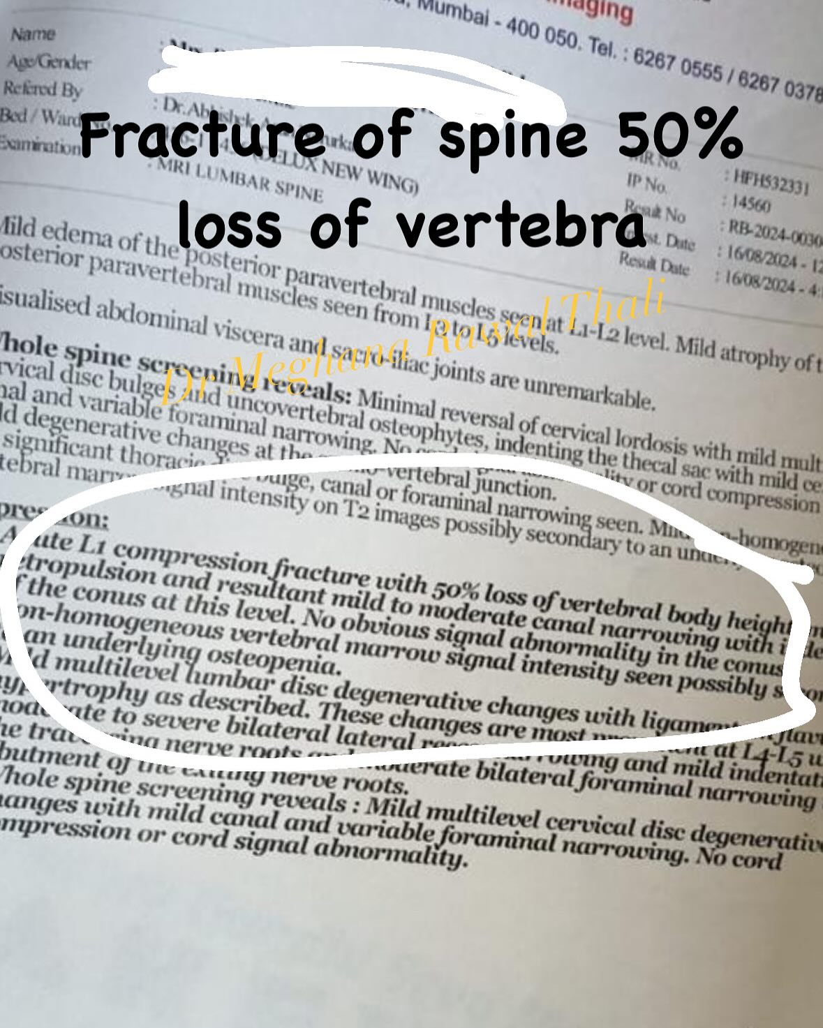 Spine Fracture Healed in 77 Year Old Female