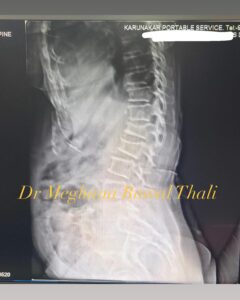 Spine Fracture Healed in 77 Year Old Female