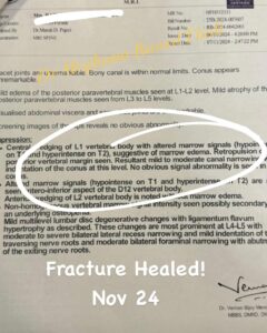 Spine Fracture Healed in 77 Year Old Female