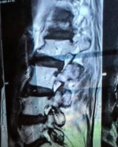 Spine Fracture Healed in 77 Year Old Female