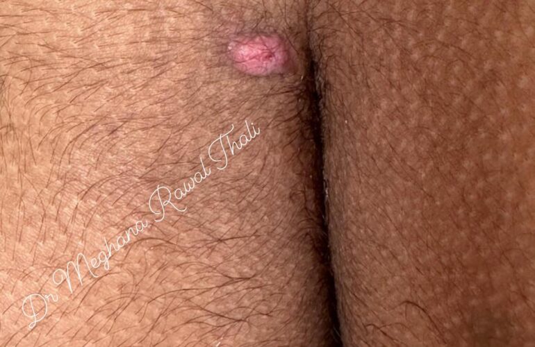 Surgical PILONIDAL CYST, Pilonidal sinus