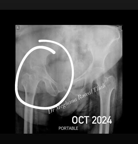 HIP-FRacture