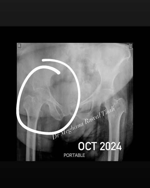 HIP-FRacture