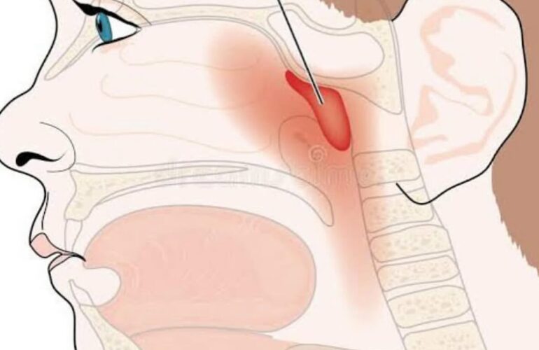ADENOID