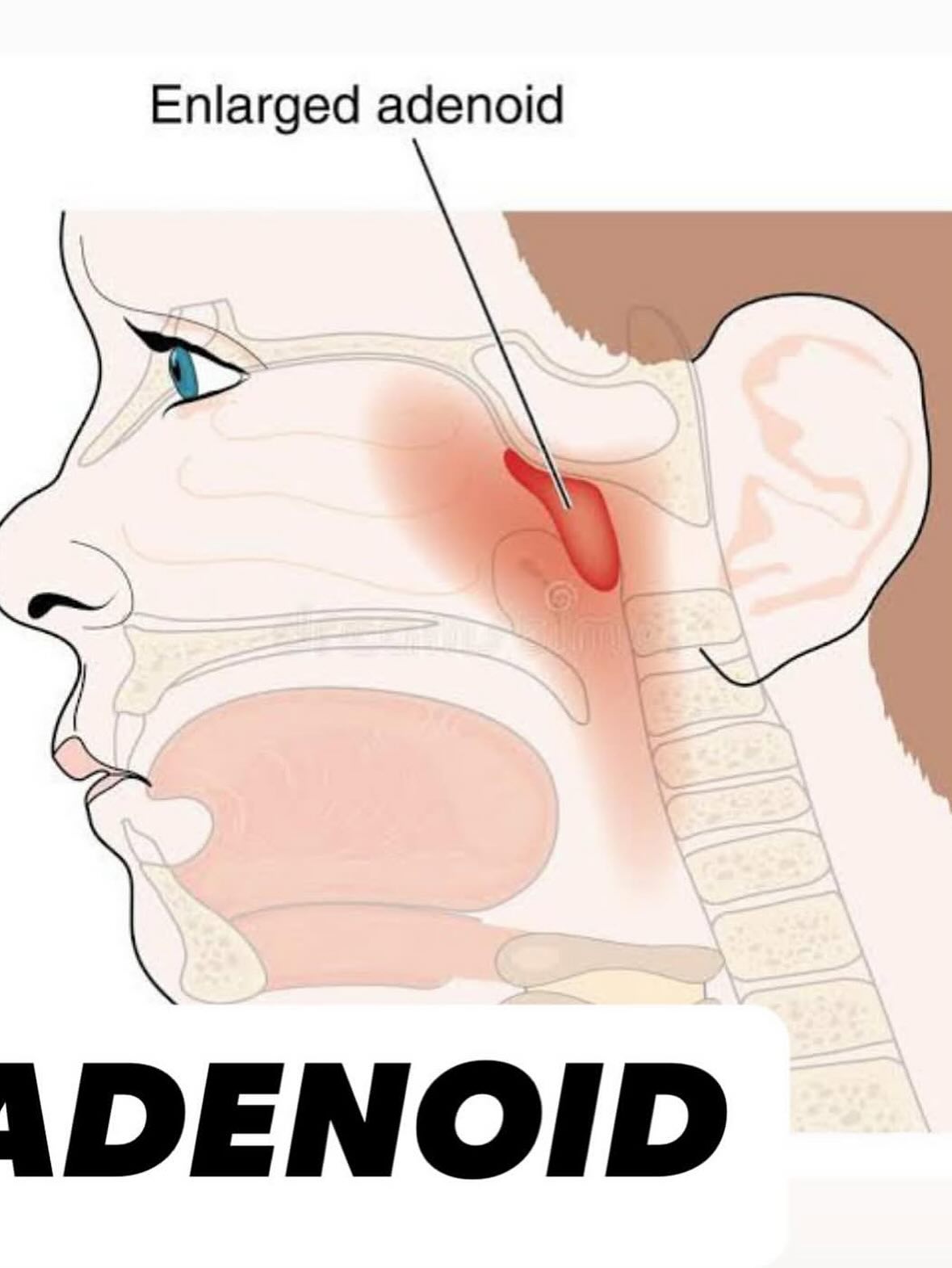 ADENOID