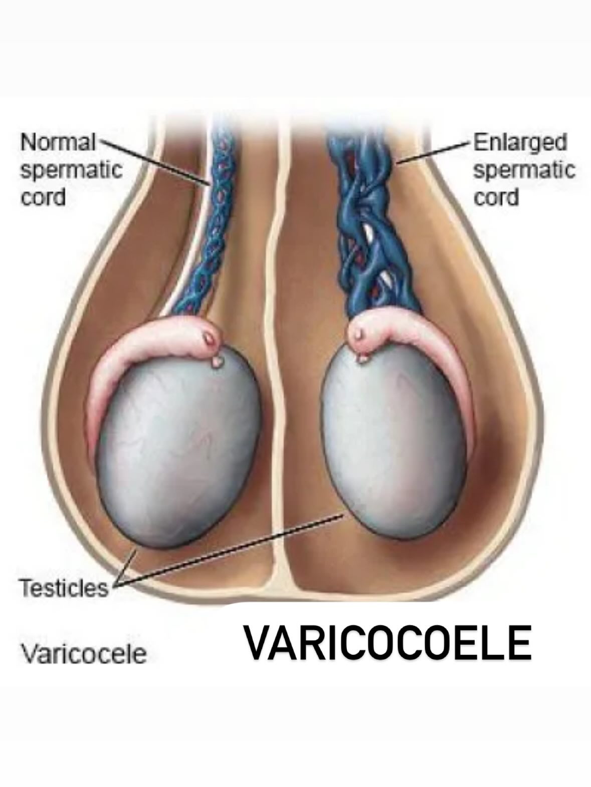 Hydroceles and varicoceles