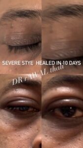 Stye