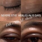Stye