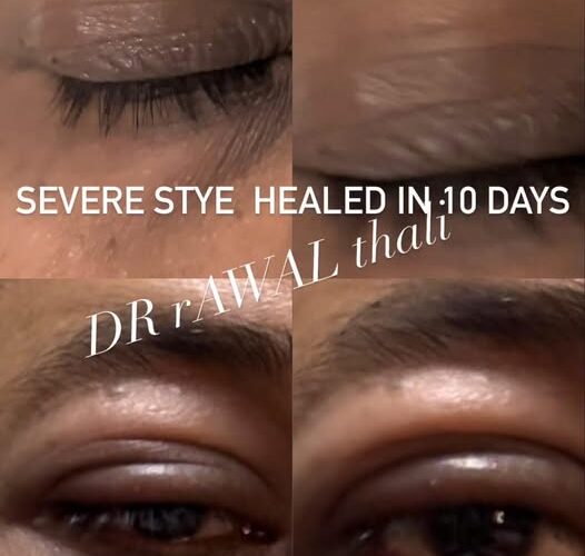 Stye