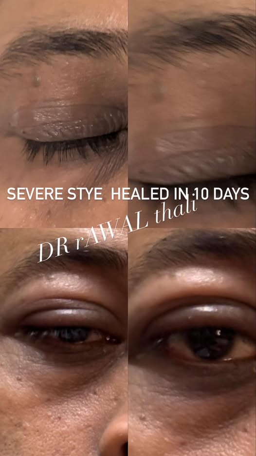 Stye
